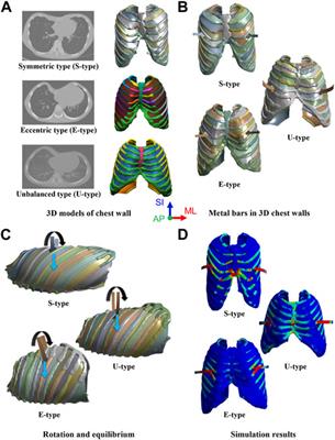 Biomechanical validation of novel Nuss procedure simulations for patients with various morphological types of pectus excavatum